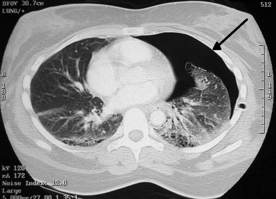 Pneumotórax ou pulmão colapsado