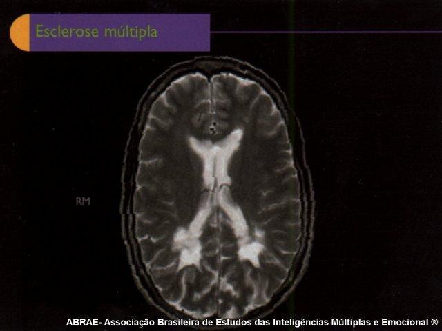 Principais distúrbios do SN Esclerose múltipla: uma