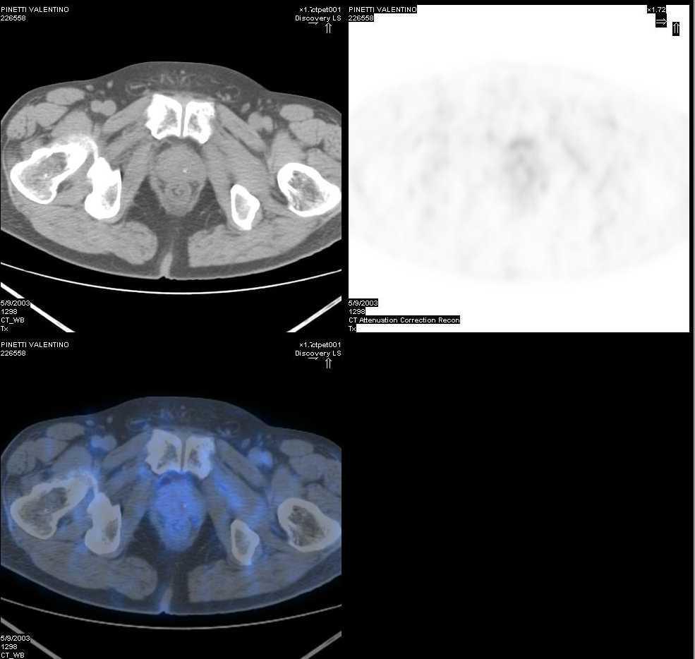 Why choline for prostate cancer imaging? 64 yo patient; PSA 12 ng/ml; indication staging.