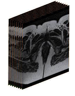 Fig. 22: Exemplo da reconstrução do pavimento pélvico a partir de imagens médicas 2D.
