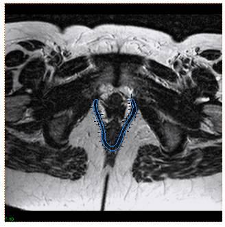 segmentação, alinhamento e reconstrução de estruturas anatómicas da coluna vertebral a partir de imagens de raios-x tendo em vista o estudo da escoliose.