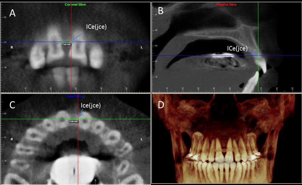 21 Figura 6 Imagem das RMPs do Software Dolphin, função Measurement com a metodologia para localização do ponto de referência na junção cemento-esmalte do incisivo central permanente superior