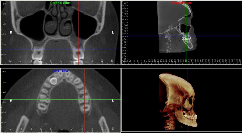 25 Figura 8 Imagem das RMPs do Software Dolphin, função Measurement ilustrando a metodologia para a localização da trifurcação dos primeiros molares: A Corte coronal com a identificação do plano