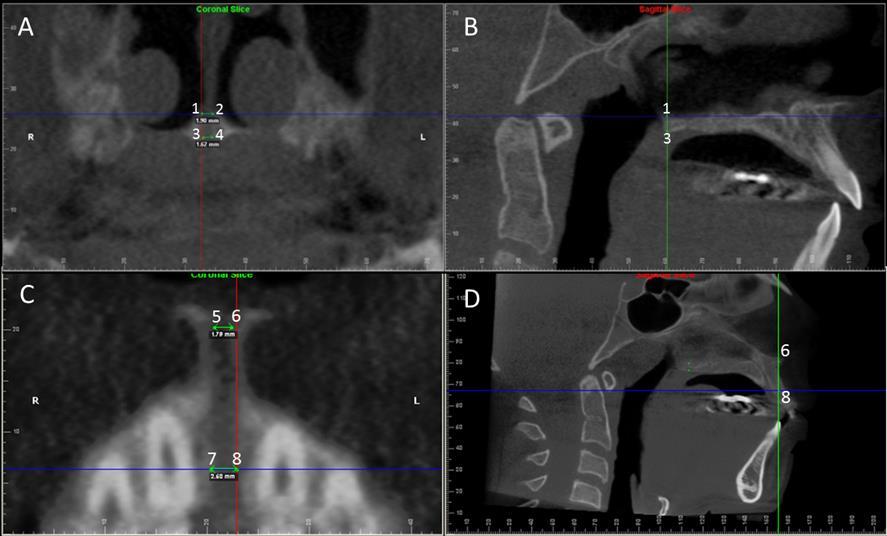 44 Figure 1 - Multiplanar reconstruction images (MPR) to measure the width of the midpalatal suture opening.