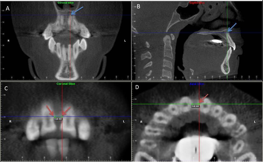 45 central incisors (CIr-CIl(ra)) and between the cementoenamel junctions of the same teeth (CIr-CIl(cej)).