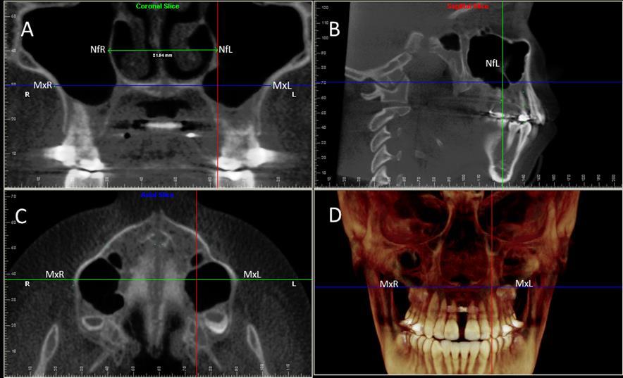 46 Figure 3 - Multiplanar reconstructions images (MPR) illustrate method to measure width of maxillary bone and width of nasal fossa: A.
