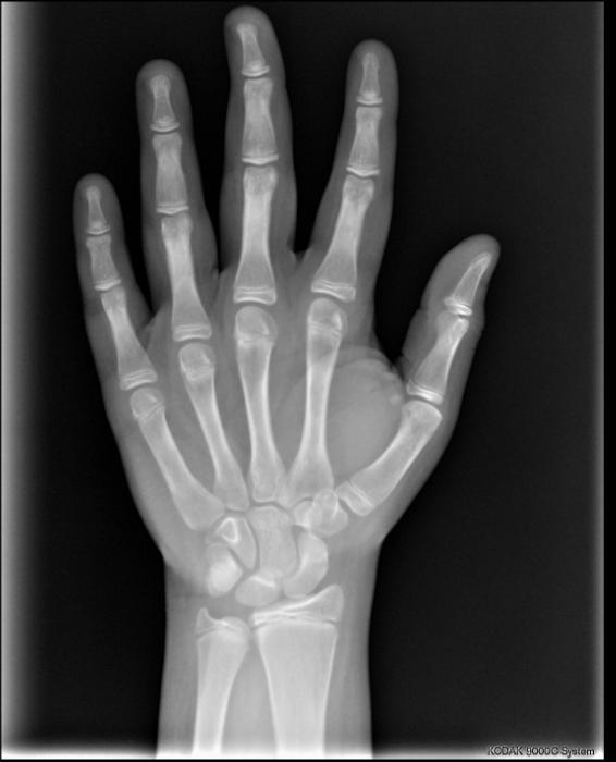 17 Figura 5: Radiografia de mão e punho para definição da idade óssea do paciente Diagnóstico e Tratamento O estudo dos exames do caso clínico em questão revelou o seguinte diagnóstico: paciente