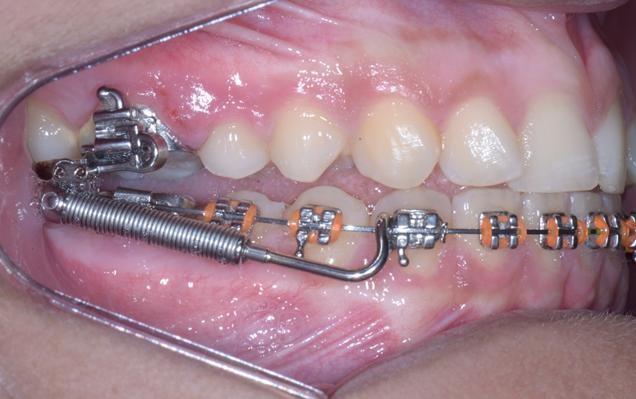 18 Inicialmente, o paciente foi encaminhado para o serviço de cirurgia oral menor, para realização de exodontia de dentes