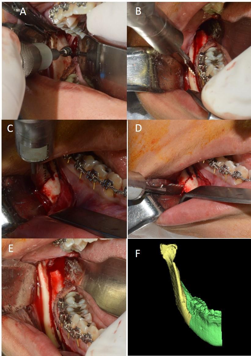 Figura 02: Técnica cirúrgica para confecção da OSBM. A: posicionamento do afastador e osteotomia com broca da porção medial do ramo mandibular, logo acima do forame mandibular.