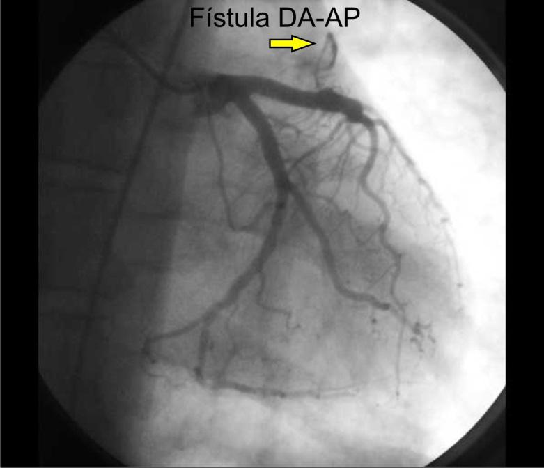 ao nosso serviço para realização de um ecocardiograma sob estresse farmacológico para investigar doença coronariana e apresentou o resultado de uma cinecoronariografia realizada previamente com a