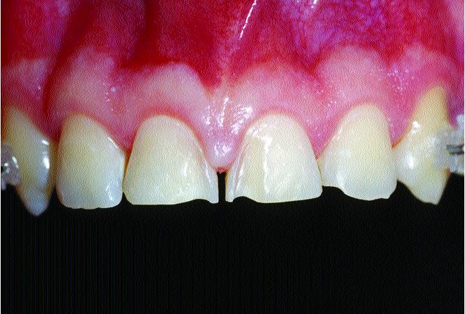 manifestar quadro de sensibilidade provocada a estímulos externos que, com o tempo, podem induzir a formação de dentina esclerótica por parte do complexo dentino-pulpar.
