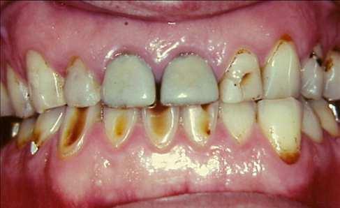 Lesões erosivas associadas com refluxo gastroesofágico apresentam-se como depressões côncavas nas superfícies palatinas e oclusais dos dentes maxilares, bem como nas superfícies linguais e oclusais