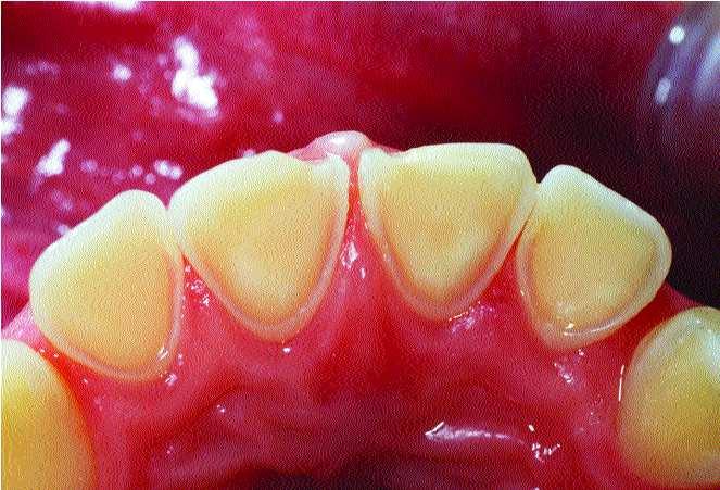 Pacientes expostos a ácidos extrínsecos sofrem maior erosão nas superfícies vestibulares e oclusais dos dentes antero superiores.