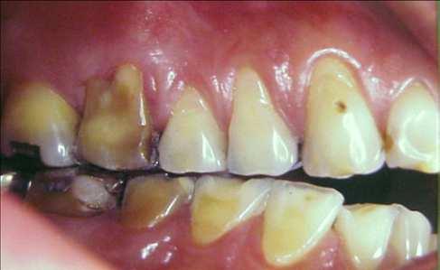 face palatina dos dentes dando um aspecto de dentes preparados com finalidade protética e término em chanfro (Figura 4).