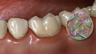 com destruição do periodonto e ocorre quando as alterações patológicas verificadas na Gengivite progridem até haver destruição do ligamento periodontal e migração apical do epitélio de união.