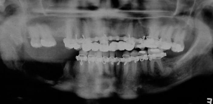 APÊNDICE G - Fixação de fratura mandibular ocorrida no