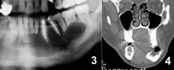 patológica (seta) na base da mandíbula; 2.