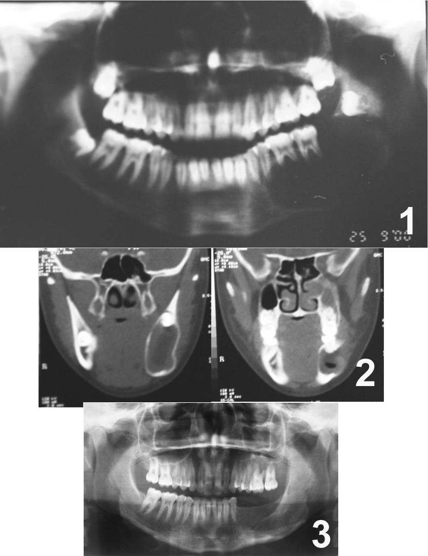 APÊNDICE M - 1. Radiografia panorâmica evidencia imagem radiolúcida unilocular envolvendo a região posterior de corpo esquerdo de mandíbula; 2.