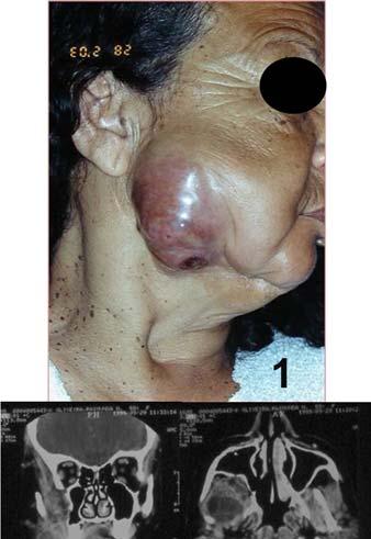 APÊNDICE R - 1. Recidiva de ameloblastoma em partes moles de região ressecada há 30 anos; 2.