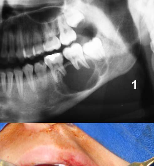 APÊNDICE S - 1. Radiografia panorâmica mostrando imagem radiolúcida multilocular e reabsorção de ápices radiculares; 2.