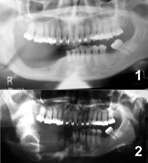APÊNDICE T - 1. Aspecto radiográfico com 2 anos de controle pós-operatório de ameloblastoma em corpo direito de mandíbula, demonstrando reparação óssea satisfatória; 2.
