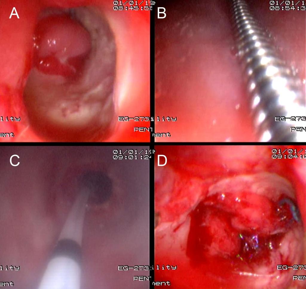33 Figura 4 Dilatação endoscópica A: Estenose em anastomose gastrojejunal associada a fístula de grande extensão B: Passagem de fio-guia metálico em alça alimentar C: Imagem obtida a partir da