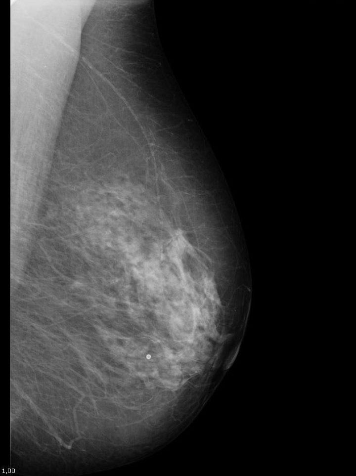 A A Fig. 2 - Imagem de Ecografia (A) A imagem de ecografia da doente da mamografia anterior, mostra uma lesão hipoecogénica, com mínima atenuação posterior.