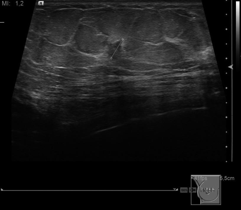 Em todas as doentes foram analisadas as mamografias e ecografias mamárias, mas apenas em 4/17 foram realizadas RM e em 2/17 estudo de tomossíntese.