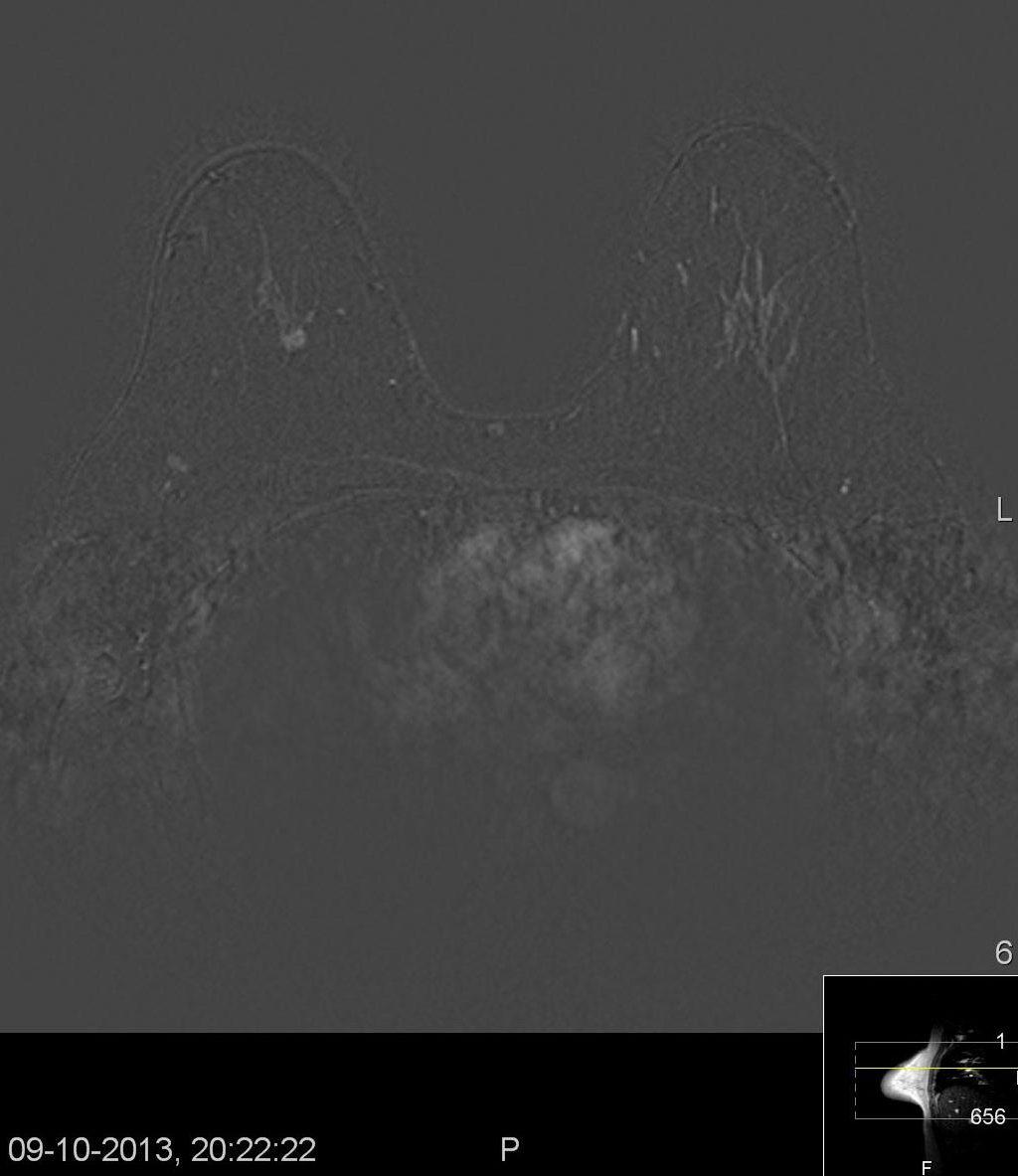 A A Fig. 3 - Imagem de RM mamária Doente de 49 anos de idade.