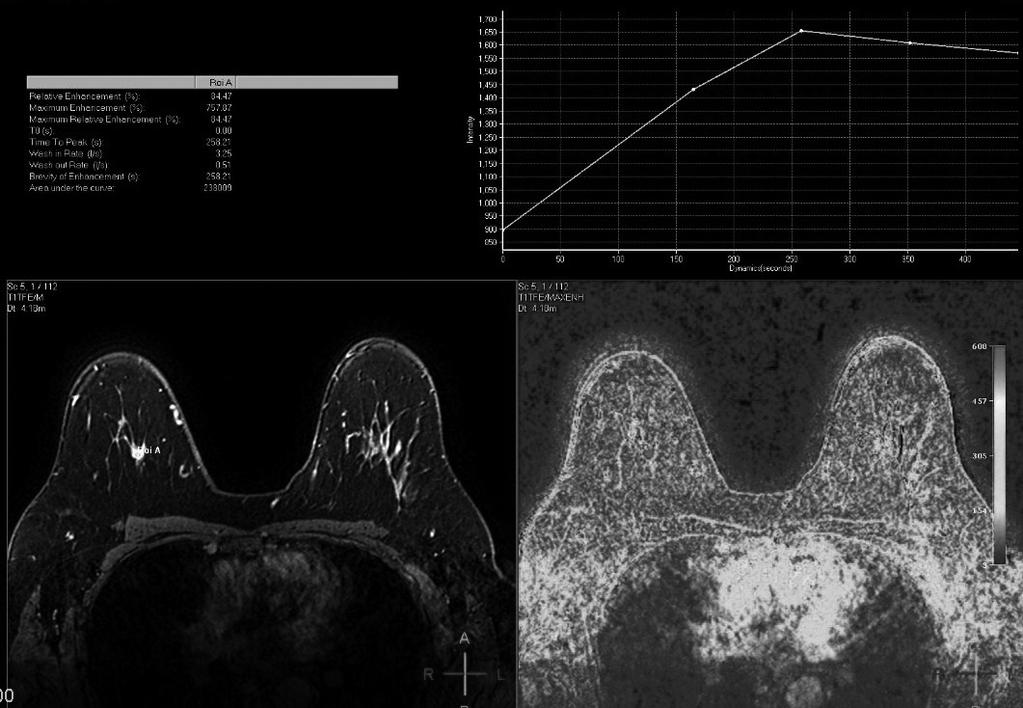 C D Discussão Os carcinomas tubulares da mama são raros e o diagnóstico definitivo é histológico [8]. As características radiológicas são consensuais na maior parte das séries apresentadas [1-5].