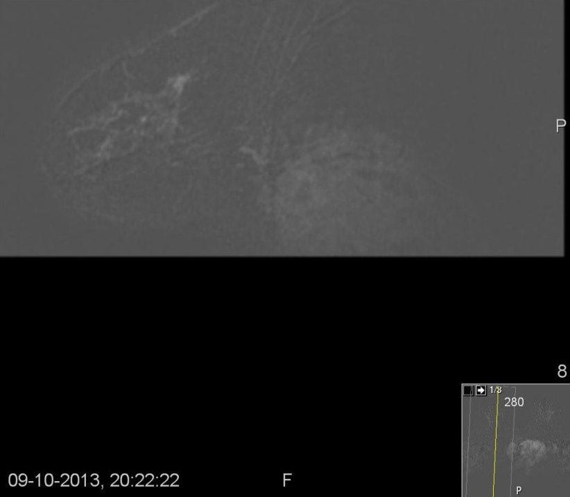 [1-3, 6]. As microcalcificações podem estar associadas a componente de carcinoma ductal in situ [3].