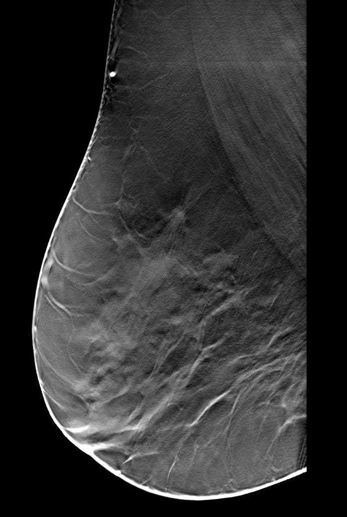 A Fig. 4 - Imagem de tomossíntese Doente de 49 anos de idade. As imagens de tomossíntese foram realizadas em MLO e CC, (A) e ().