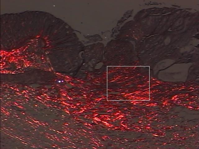 Figura 8 - Fotomicrografia da região estudada da anastomose de caso do grupo controle no 14º