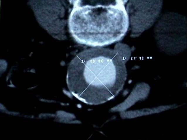 Estudo de Imagem Pré-operatório A tomografia computadorizada helicoidal do abdome foi realizada com cortes de 5mm de espessura, a intervalos de 2,5mm, com a administração endovenosa de 120 a 140ml de