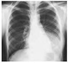 Introdução 1. Pneumonia 470 milhões de casos/ano 1 4 milhões de óbitos 1 2.