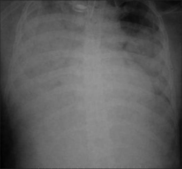 Venkategowda et al; Prone position and pressure control inverse ratio ventilation in H1N1