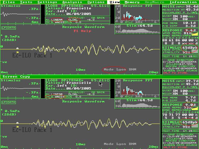 Método 55 intensidade de 60 a 65 db, na modalidade Lyon Mode (modo linear), com relação sinal/ ruído entre 0 e +5 db, e janela de 20 milisegundos (Figura 3).