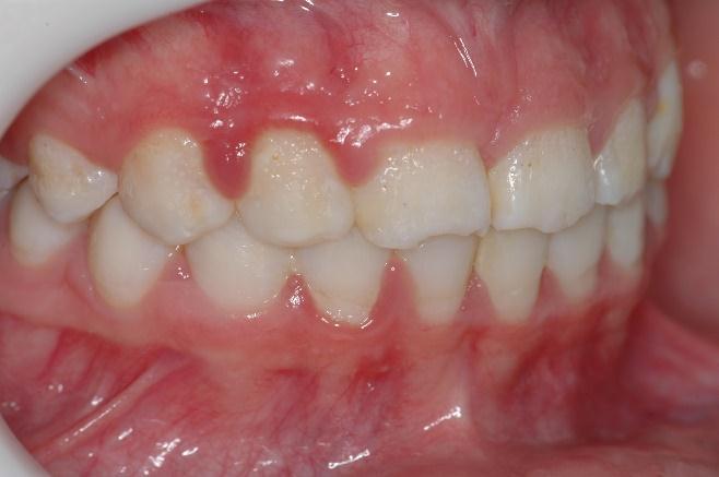 Durante o exame clínico constatou-se uma higiene oral insatisfatória, estabelecendo assim, um quadro de gengivite aguda generalizada, com hiperplasia