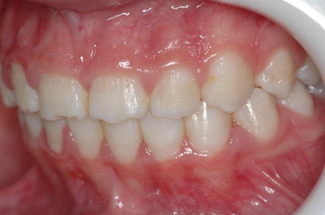 Nota-se também que todos elementos dentários possuem deficiência na formação do esmalte, deixando os dentes com um aspecto rugoso e poroso, caracterizando
