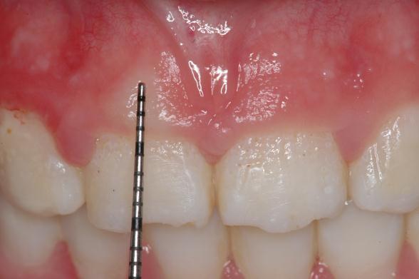 profilaxia, motivação e instruções de higiene, durante um mês para adequação do meio bucal e reestabelecimento da saúde periodontal.