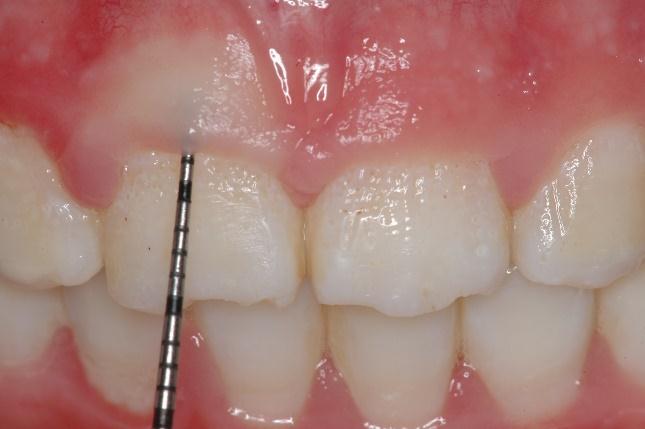 Realizou-se sondagem periodontal de todos os dentes, encontrou-se profundidade de sondagem de aproximadamente 5 mm, que possibilitava a remoção de 2 mm de tecido gengival (figura 2). A B Figura 2.