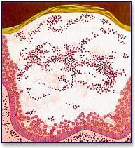 Bolha - representação esquemática Vesículas e bolhas: herpes