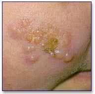 Dermatite Herpetiforme de Dühring -Brocq PÚSTULA Elevação