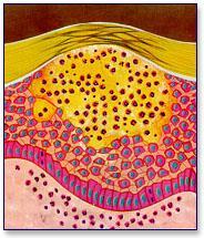 Pústula - representação esquemática Pústulas assépticas: psoríase pustulosa