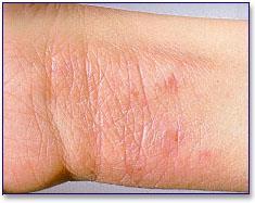LIQUENIFICAÇÃO Espessamento da pele com acentuação dos sulcos ou do quadriculado normal da pele, em decorrência do ato de coçar