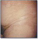 ESCLEROSE Liquenificação na dermatite atópica Alteração da espessura e da consistência da pele que torna-se rígida, perde o pregueado