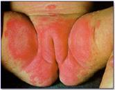As manchas ou máculas podem ser de dois tipos, conforme suas origens: Vásculo-sangüínea - Decorrente de congestão ou constrição