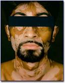 Acromia ou mancha a crômica: vitiligo HIPERCROMIA Ocorre por depósito de
