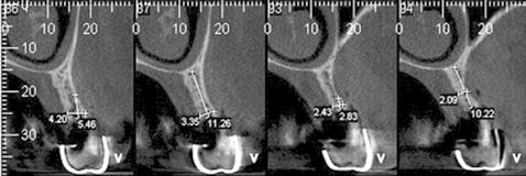 implante instalado na altura da fossa nasal ().