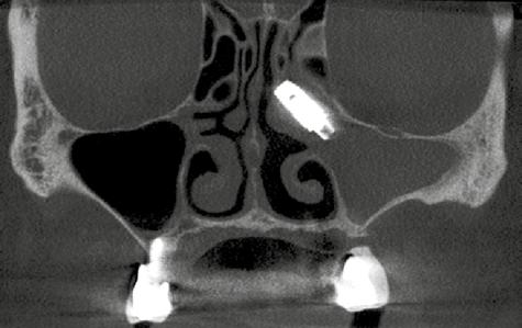 fenestração da fossa nasal causada pelo